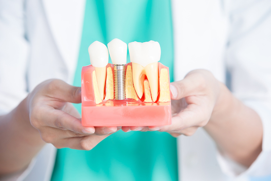 インプラントと入れ歯の違いをご存知ですか？