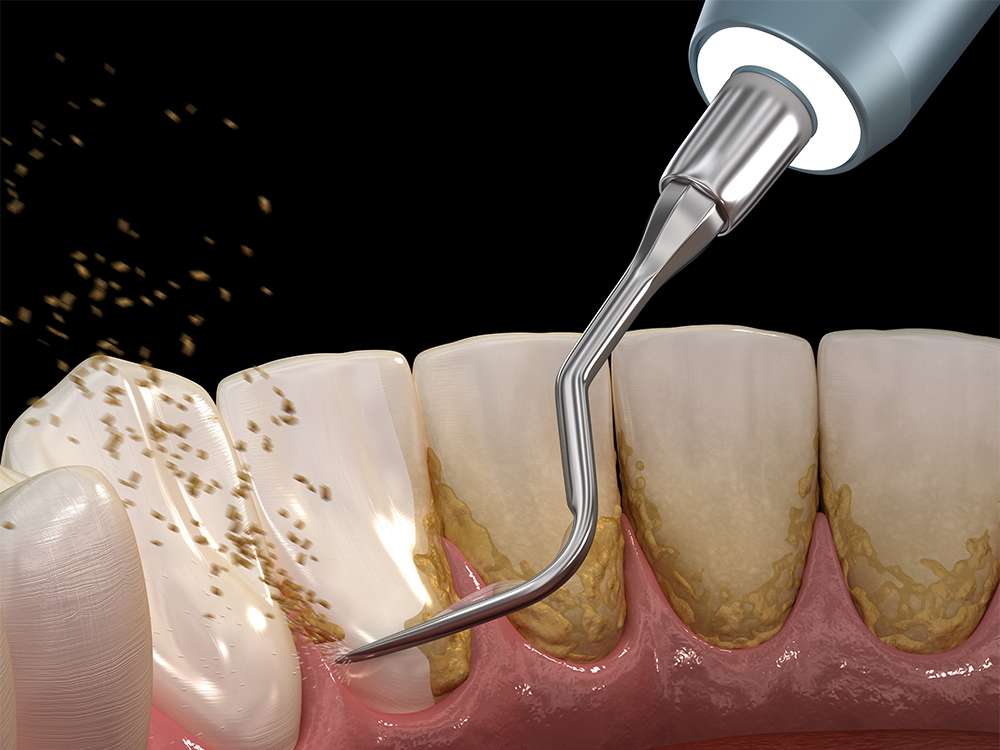 歯垢(プラーク)と歯石の違いをご存知ですか？