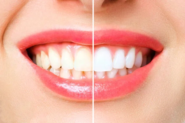 黄ばんだ歯と白い歯の比較