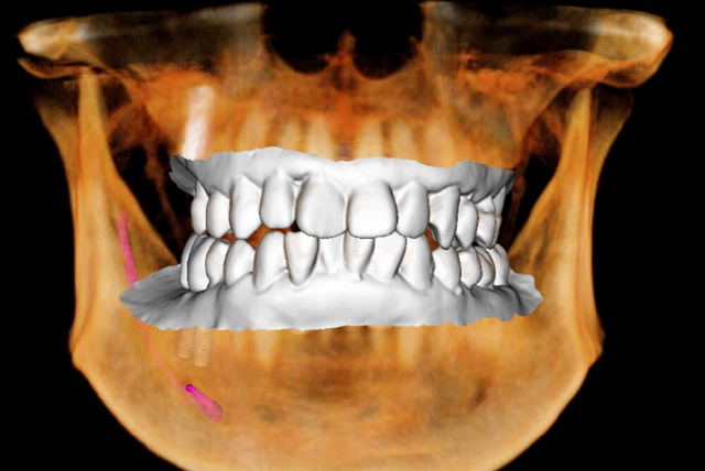 歯のCT画像